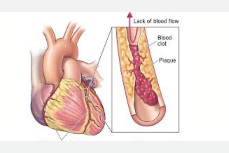 Lesson 4.8 - Coronary Artery Disease